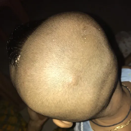 On My Baby Back Head This Bump Is There She Frequently Fall On Back Head But She Is Normal In Eating Activities Etc Can I Know This Bump Is Normal In Children Or