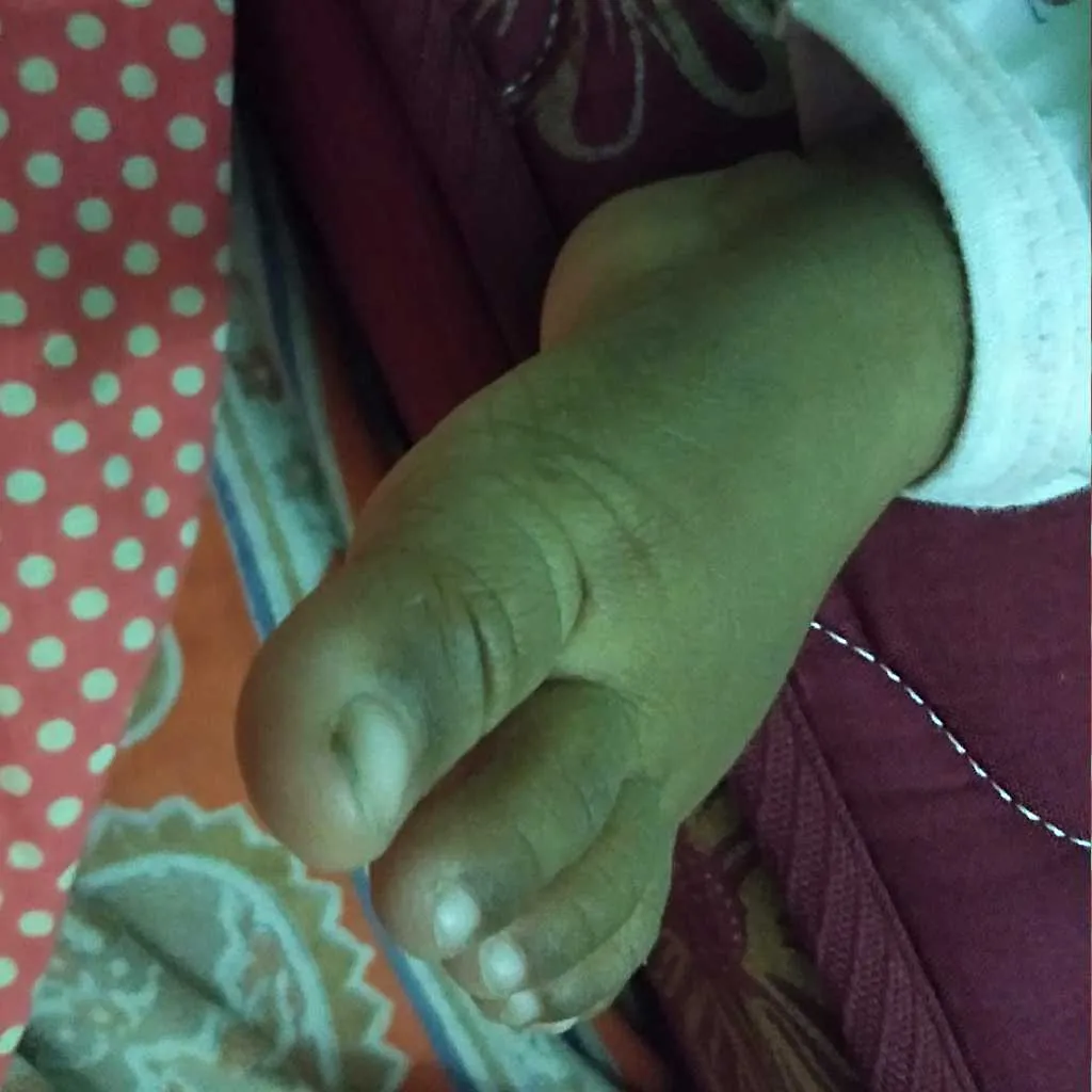 my baby fingers of leg near nail is black... does this mean his body colour  become black – FirstCry Parenting