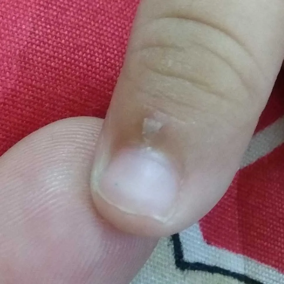 ParentingClinic #BabySkinCare please advise why his skin peeling near nails.  is that because of any deficiency?? – FirstCry Parenting