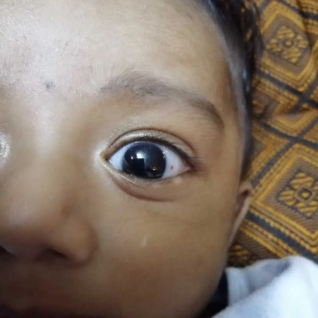 Hi.. My has a spot in his eye.. Can you please tell me what need to do since I'm unable see a doc now. – FirstCry Parenting